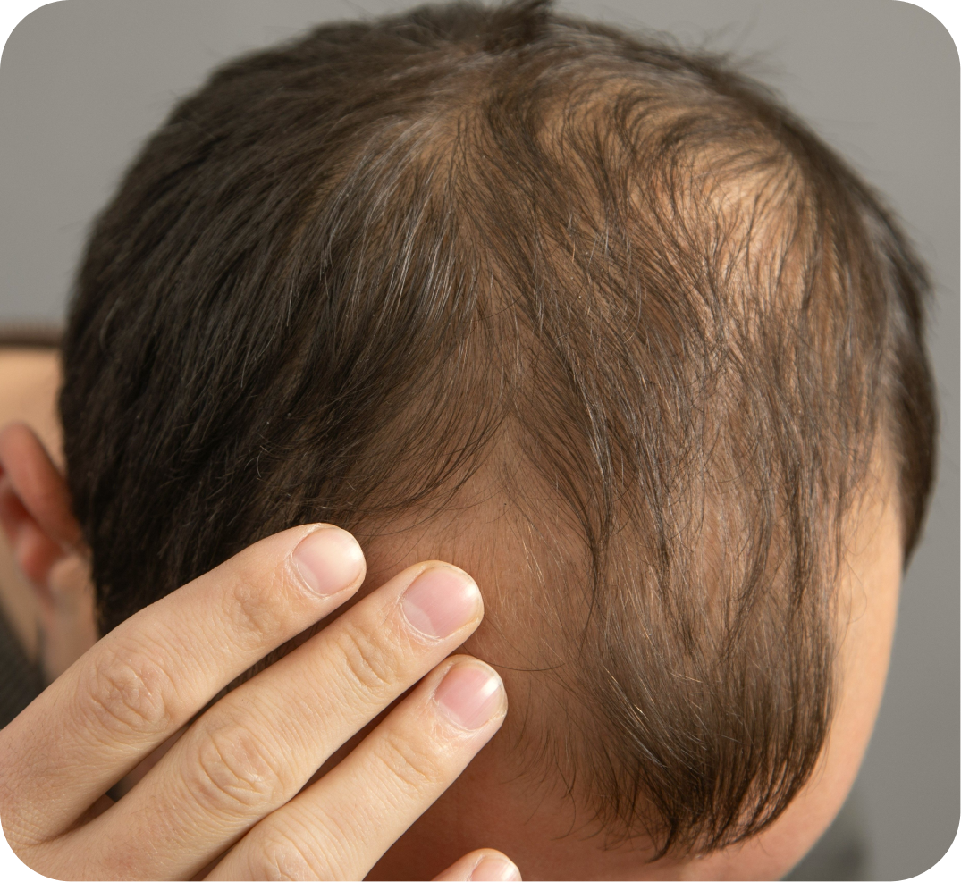 التساقط عند الرجال