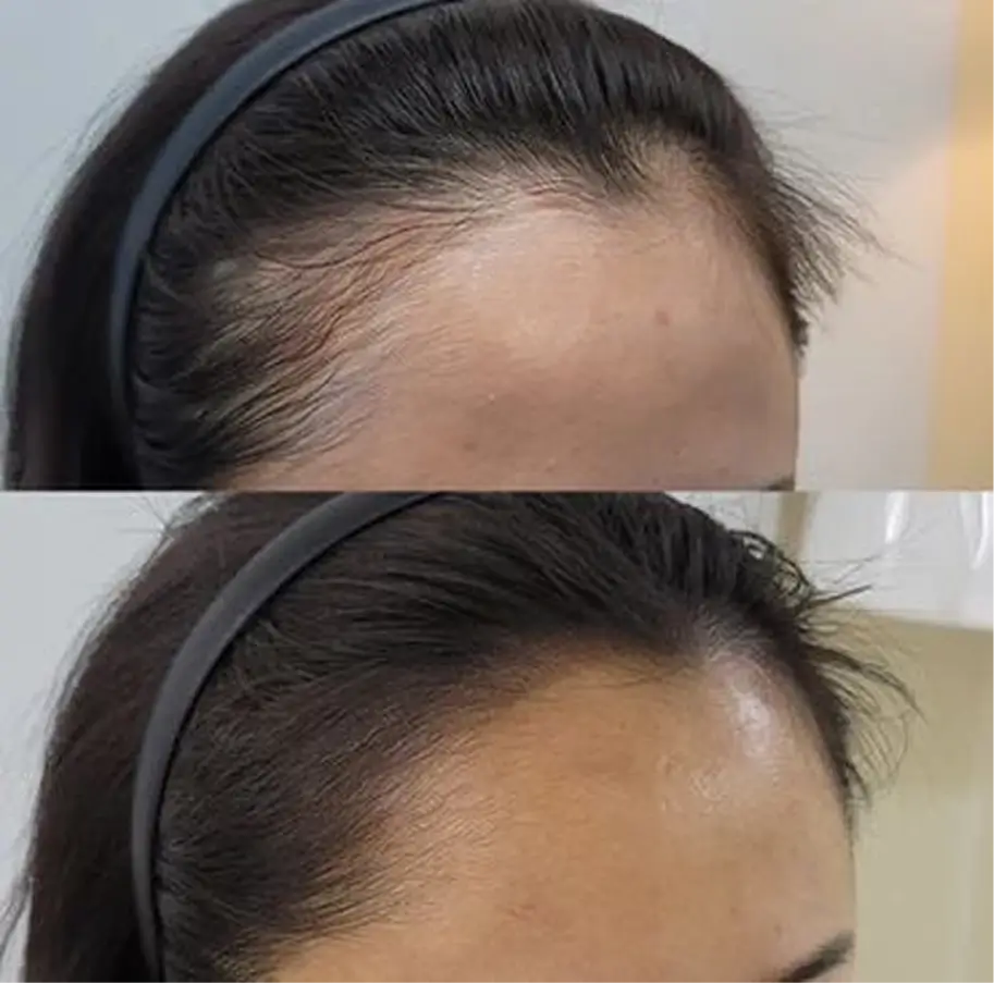 نتيجة حقيقية لزبونة كاميليا — قبل وبعد