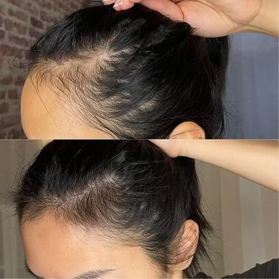 نتيجة حقيقية لزبونة كاميليا — قبل وبعد